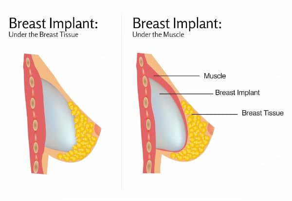 breast-augmentation