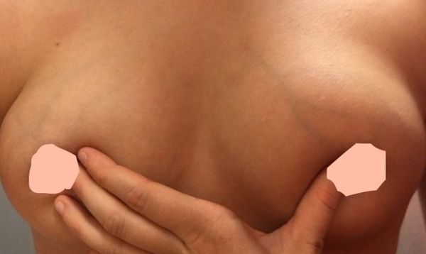 veins in breasts during pregnancy