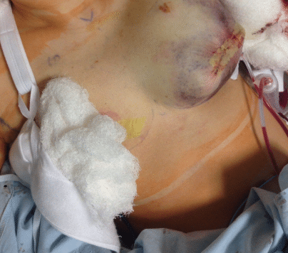 hematoma after breast augmentation pictures