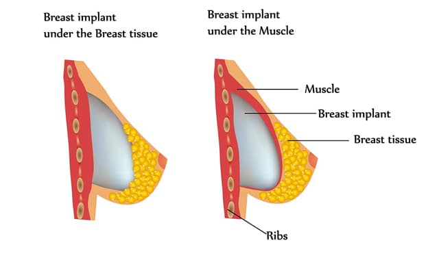 comparison of breast implant placed under breast tissue vs. under chest muscle