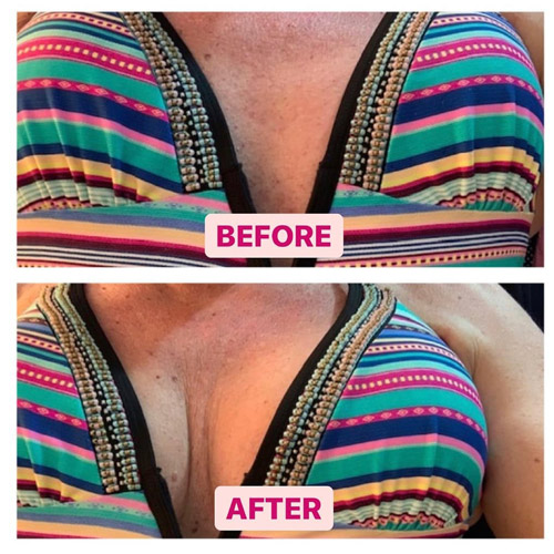 fenugreek breast enhancement before and after pictures