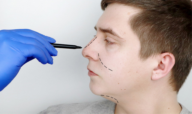 male rhinoplasty procedure